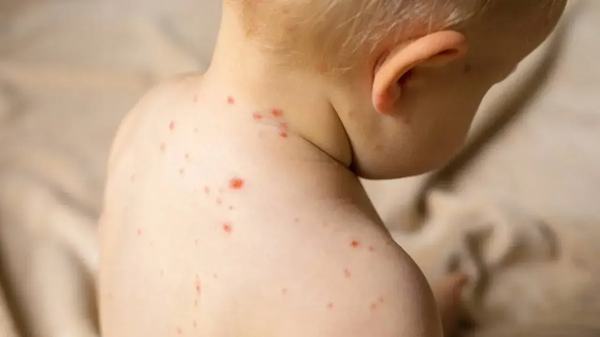 Бангладеш начинает экстренную вакцинацию от кори после смерти 100 детей за месяц