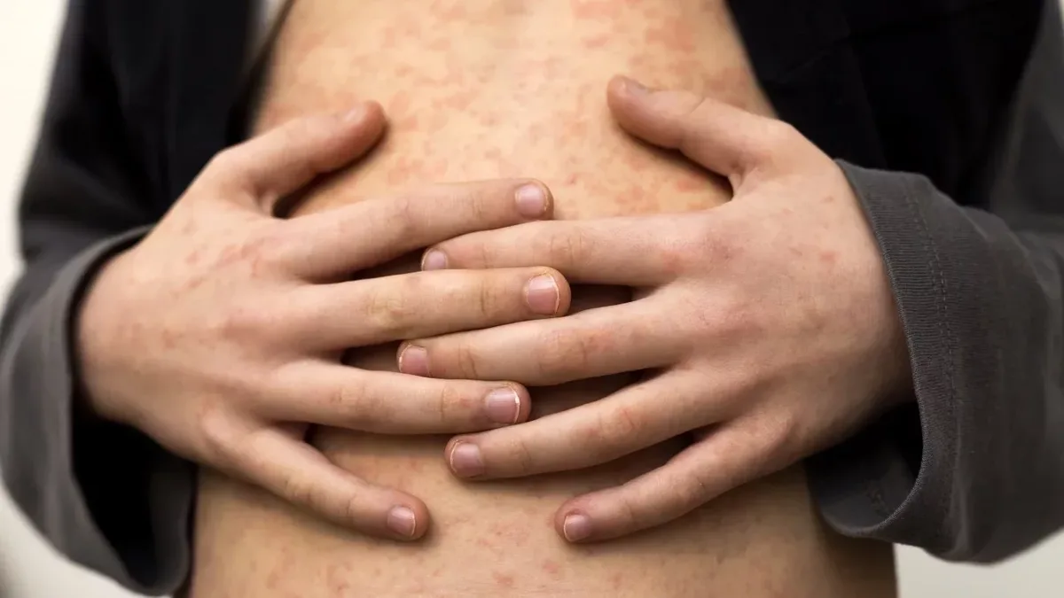 Бангладеш запускает экстренную вакцинацию после смерти более 100 детей от кори