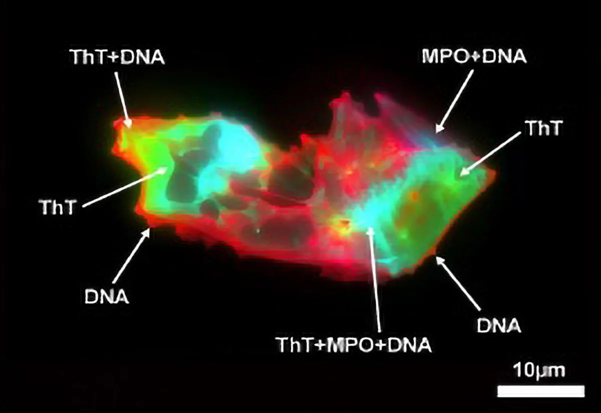 Nature reveals viral DNA links to Hodgkin's lymphoma in biobank study