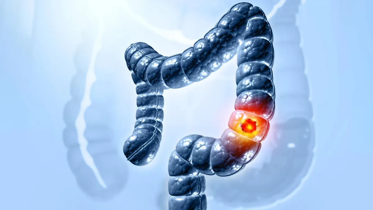 Study identifies how gut bacterium triggers colon cancer